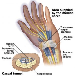 Carpal Tunnel - Gold Coast Hand + Upper Limb Clinic