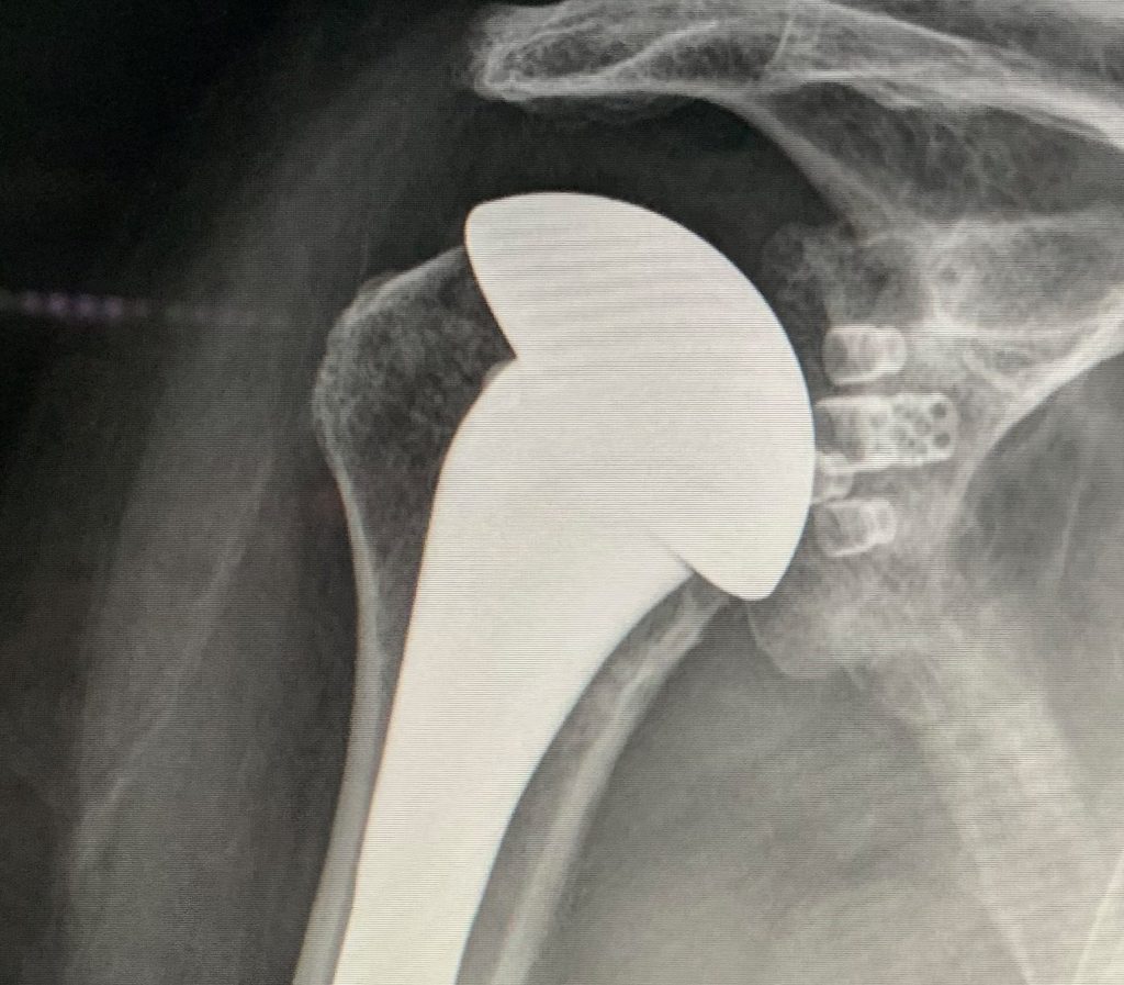 Shoulder Joint Replacement Gold Coast Hand + Upper Limb Clinic