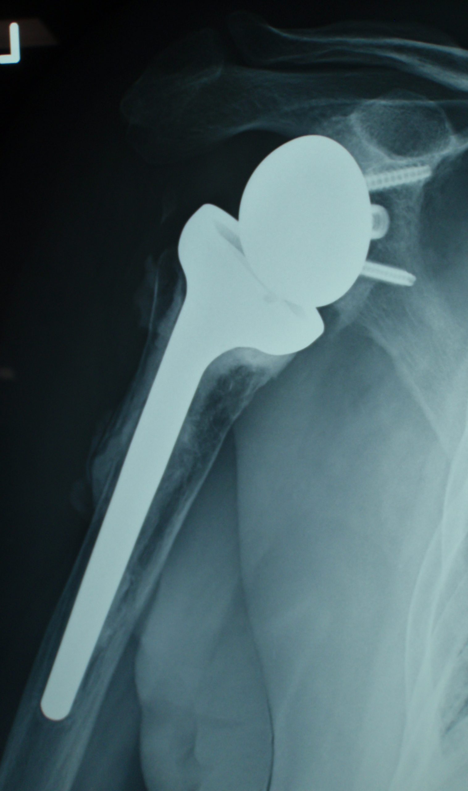 Shoulder Joint Replacement Gold Coast Hand + Upper Limb Clinic