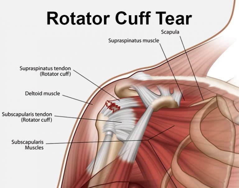 Rotator Cuff Tear - Gold Coast Hand + Upper Limb Clinic