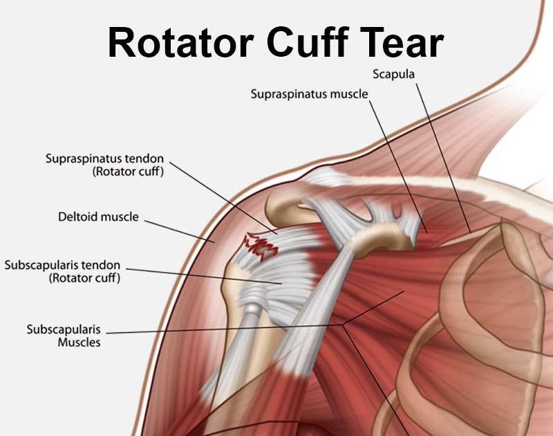 Torn tendon on sale in shoulder